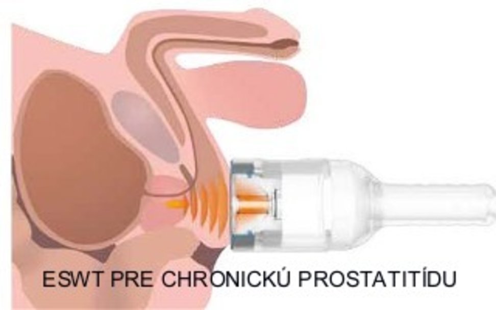 Chronicka_prostatitida_/ESWT_P.jpg