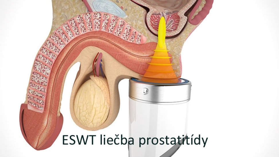 Chronicka_prostatitida_/ESWT_prostatitis.jpg