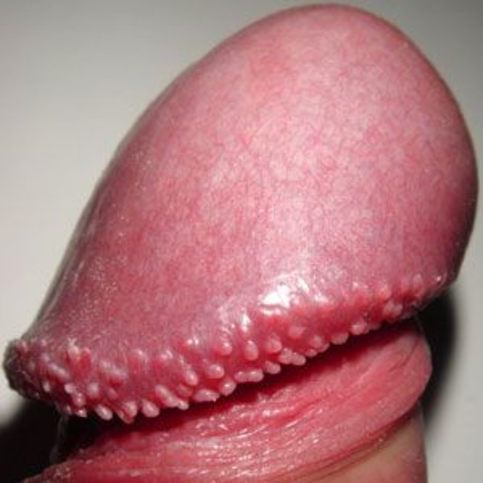 PPP__bradavice/Vyrastky_penisu_pearly_penile_papules_2.jpg