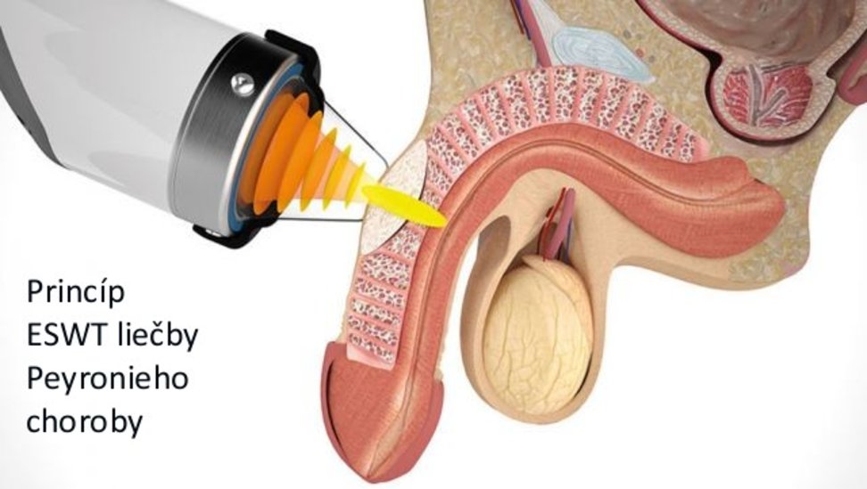 Peyronie/induratio-penis-plastica_ESWT_liecba.jpg